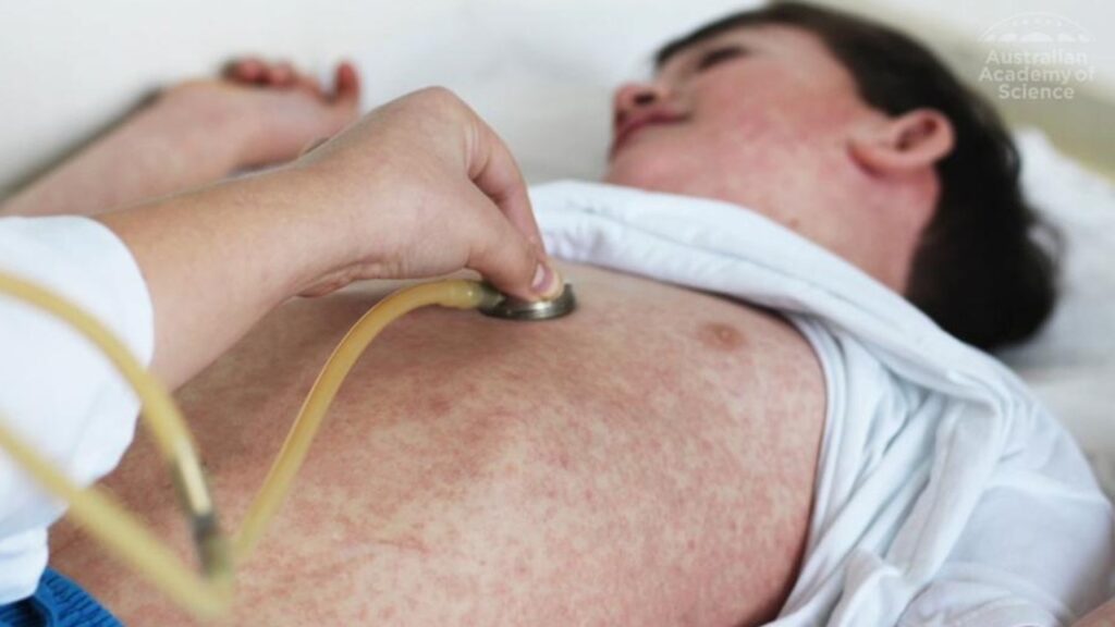 urgent-measles-warning-after-baby-infected